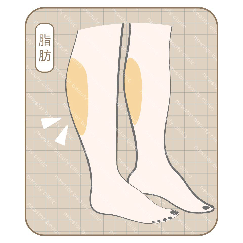 瘦小腿_脂肪型