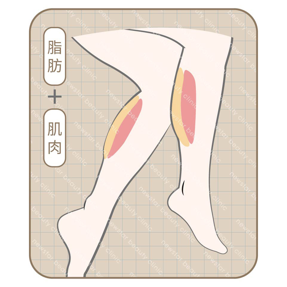 瘦小腿_脂肪+肌肉型