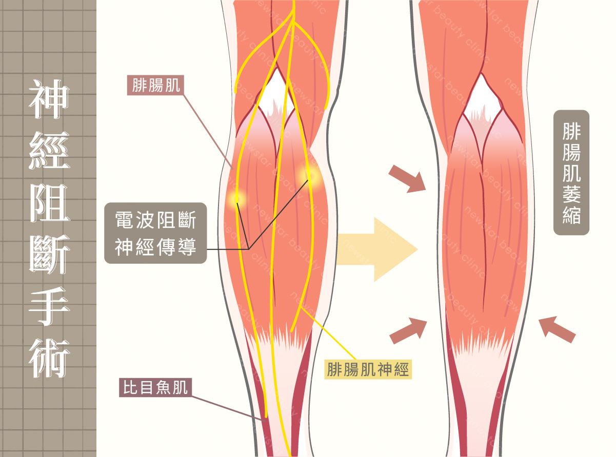 瘦小腿_腓腸肌切除手術