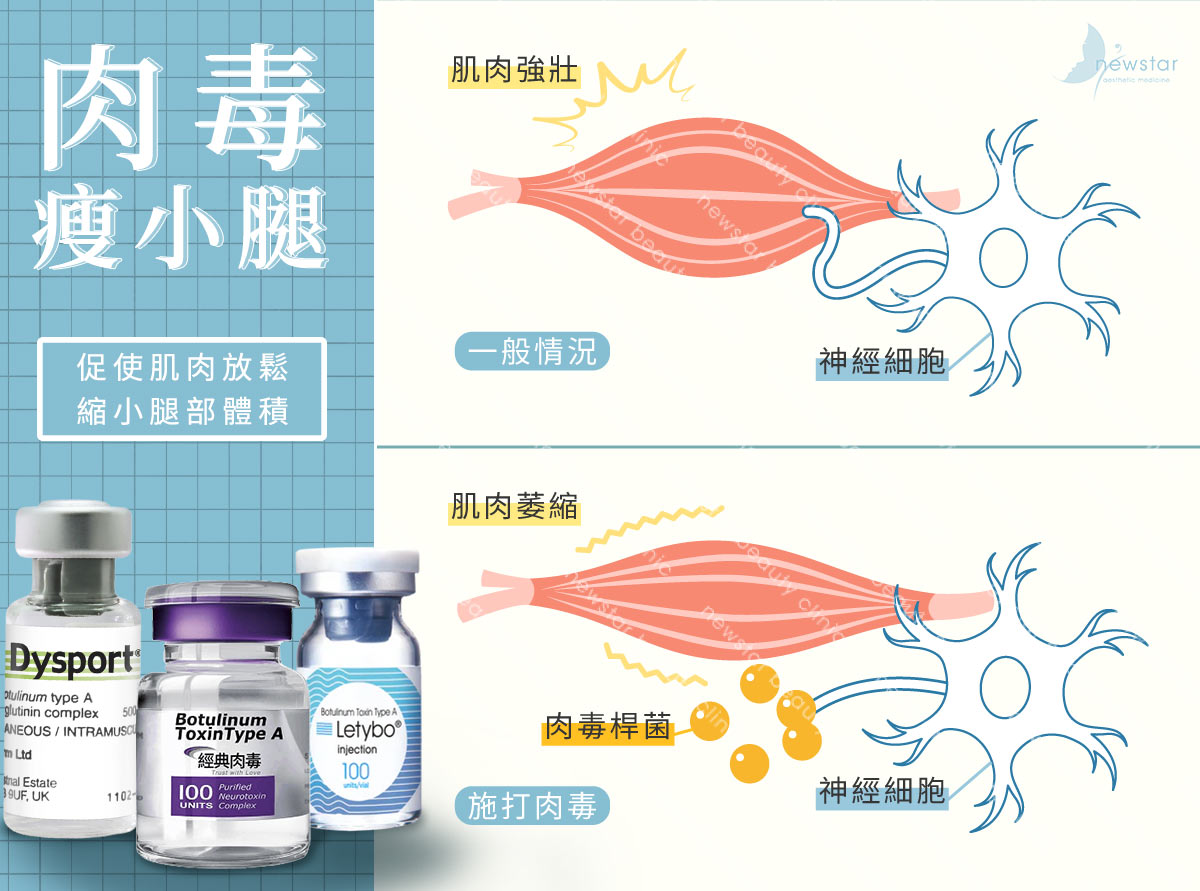瘦小腿療程_肉毒