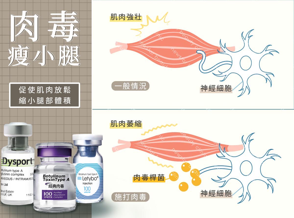 瘦小腿方式_肉毒小腿