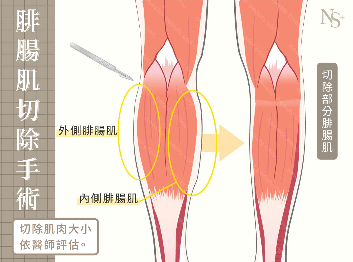 瘦小腿_腓腸肌切除手術