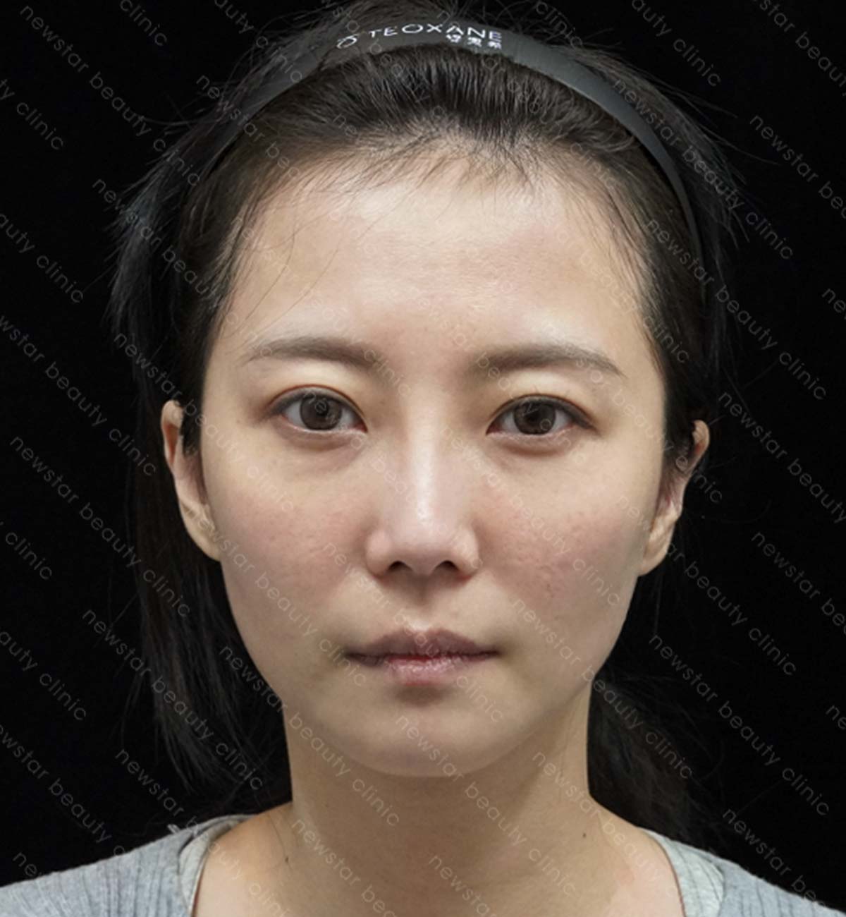 手臂抽脂術後_側面_before