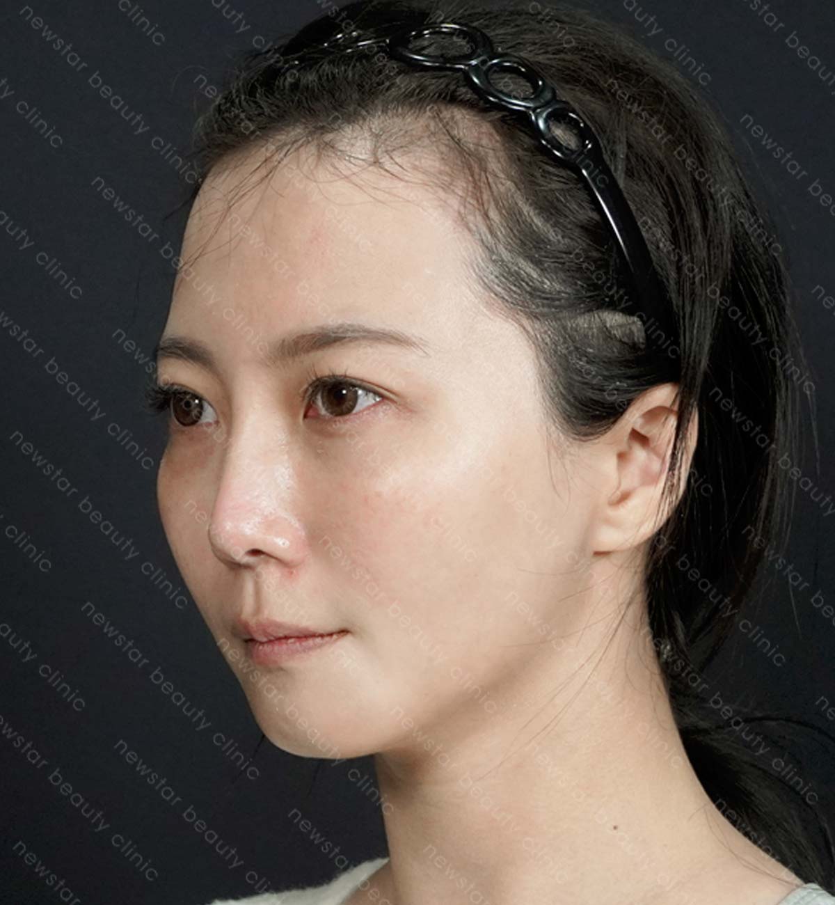 手臂抽脂術後_正側_after