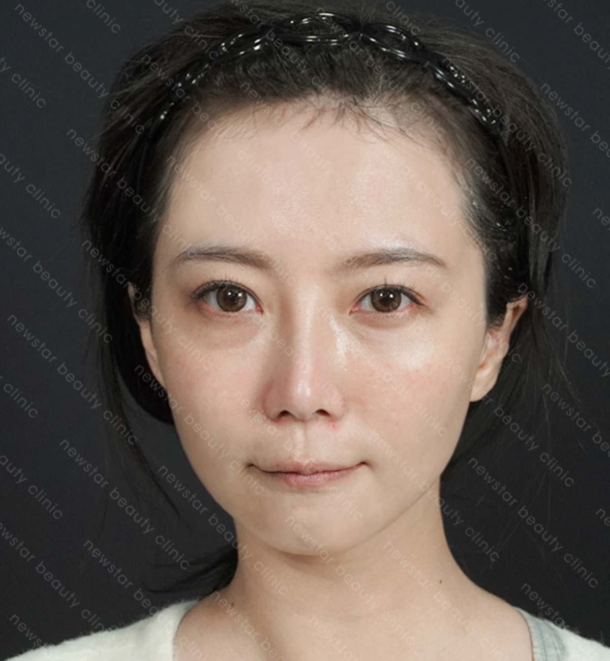 手臂抽脂術後_側面_after