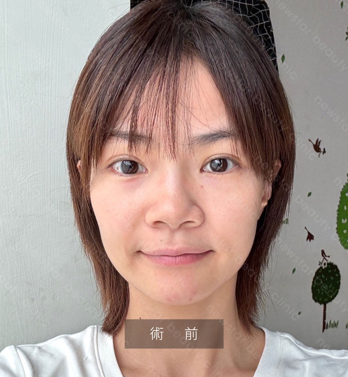 輪廓固定_恢復期_術前01