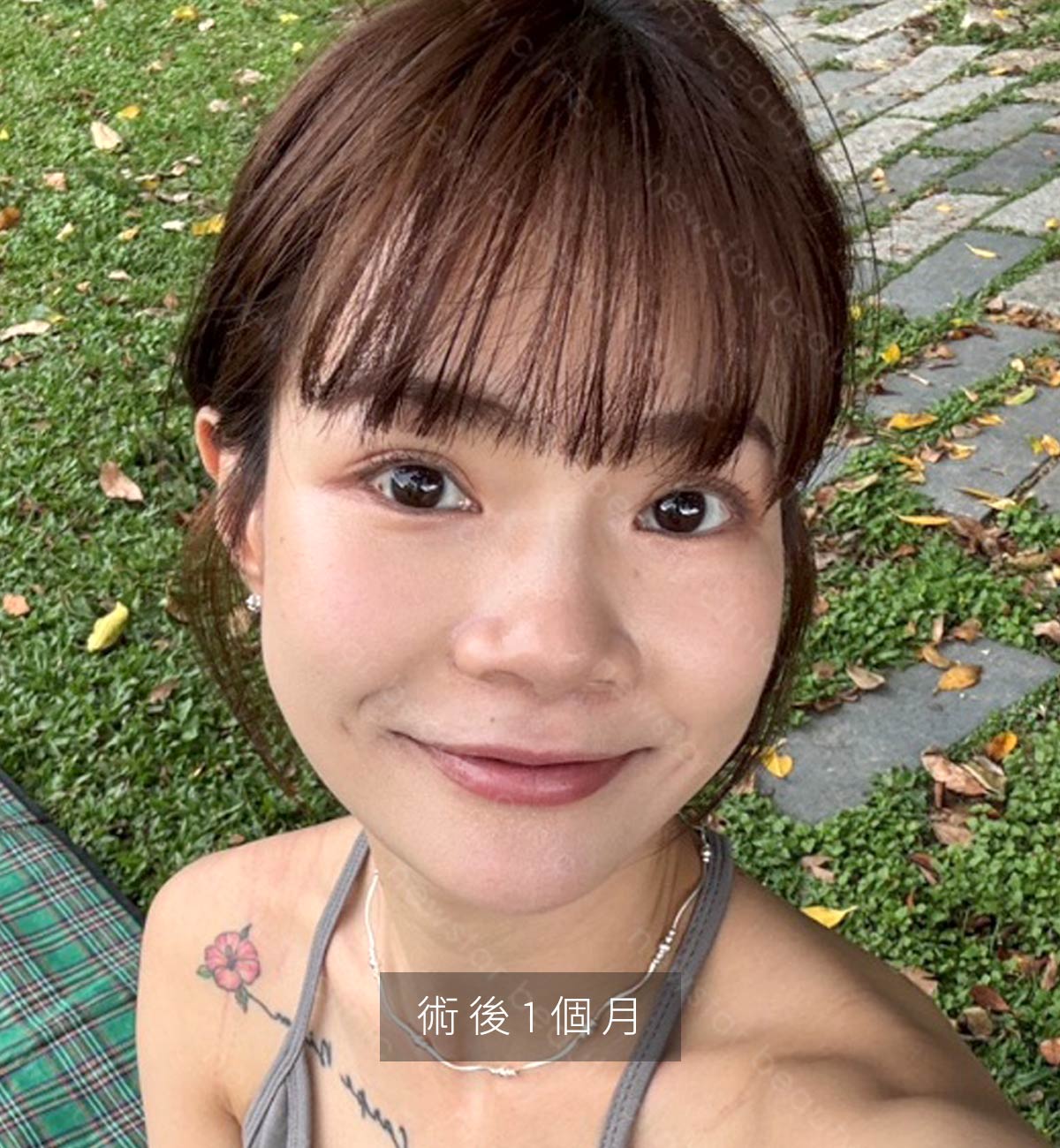 輪廓固定_恢復期_術後1個月01