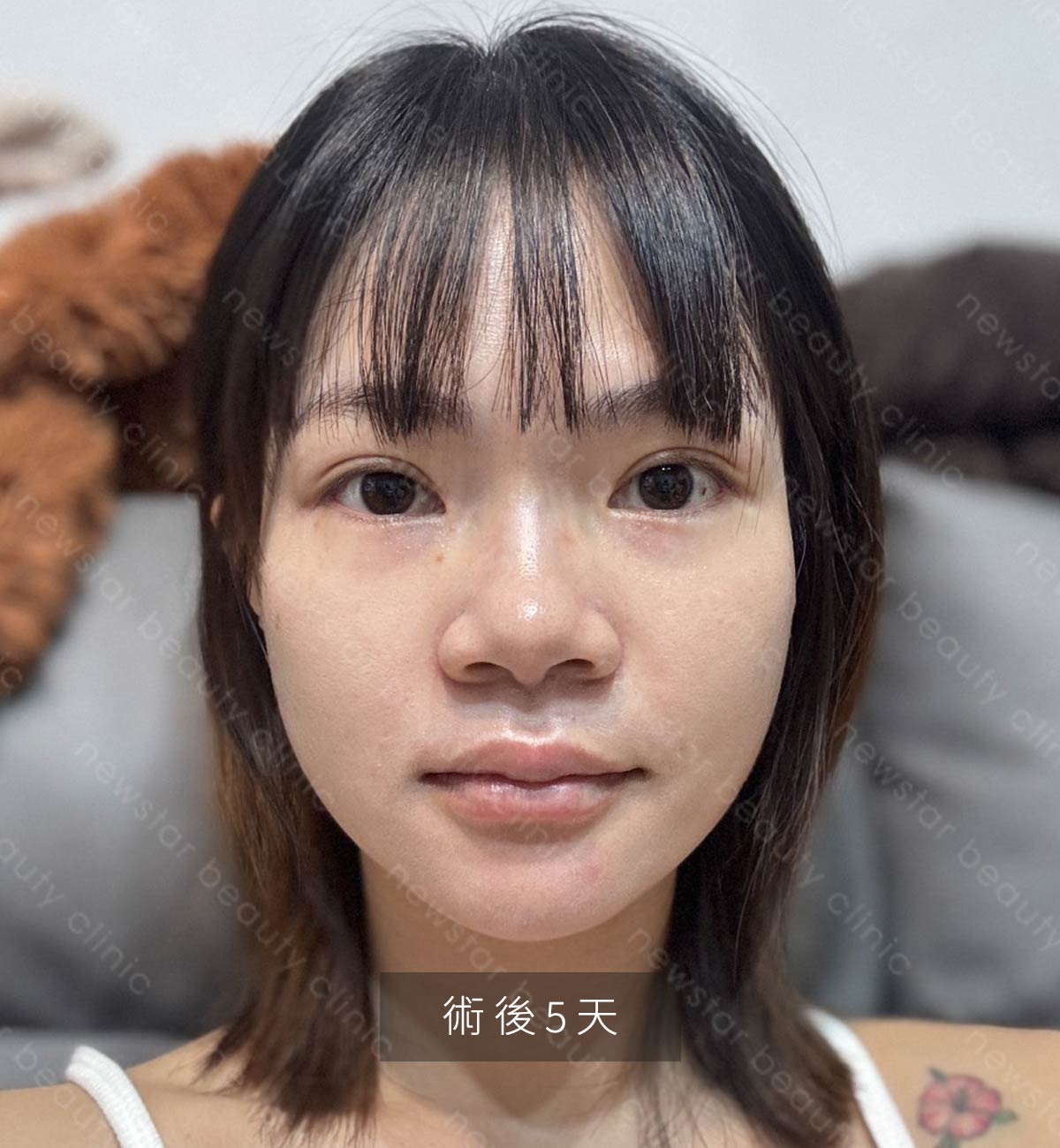 輪廓固定_恢復期_術後5天01