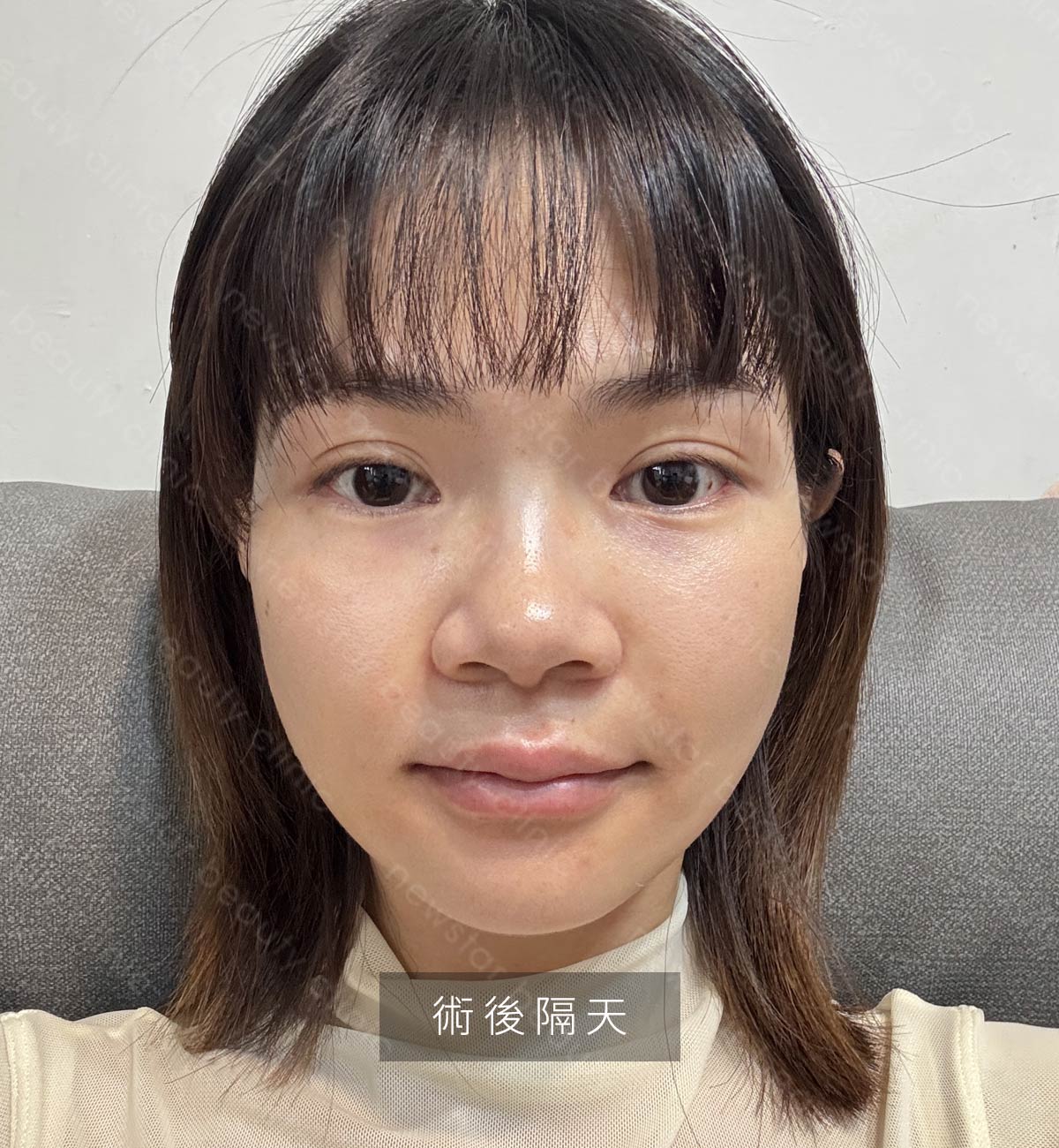 輪廓固定_恢復期_術後隔天01