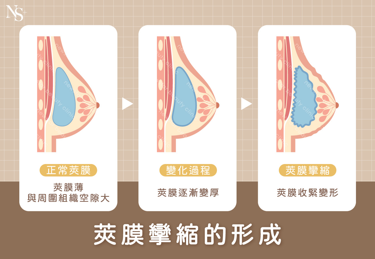 隆乳按摩_莢膜攣縮形成