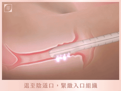 蝴蝶雷射_入口私密處緊緻GIF