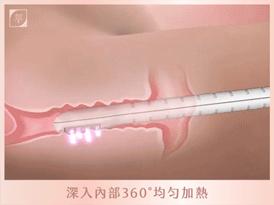 蝴蝶雷射_深入私密處緊緻GIF