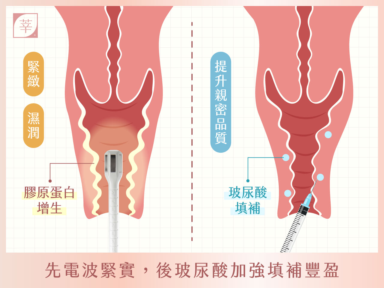 蝴蝶電波_蝴蝶+玻尿酸