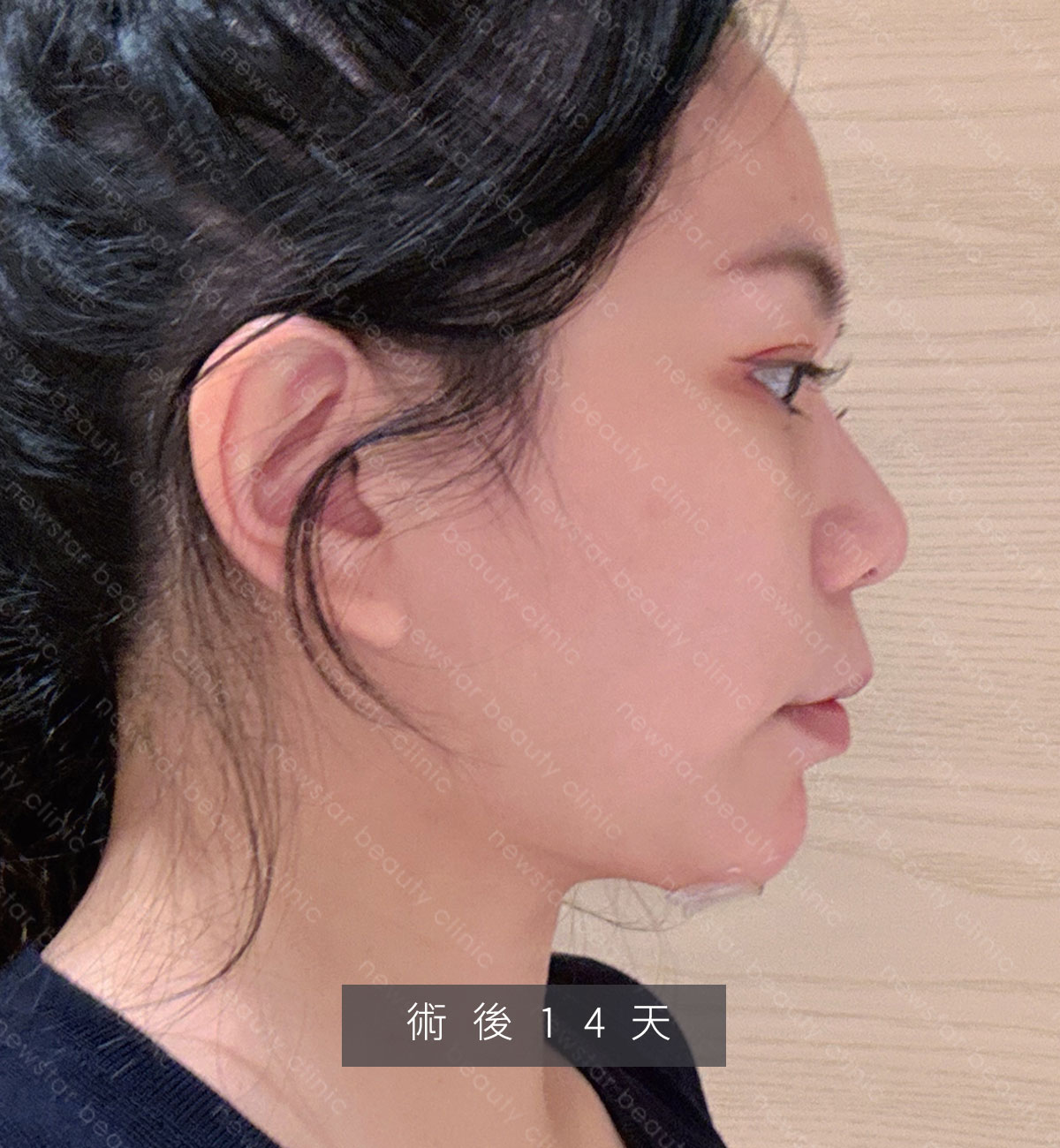天鵝頸手術_捏捏_術後14天01