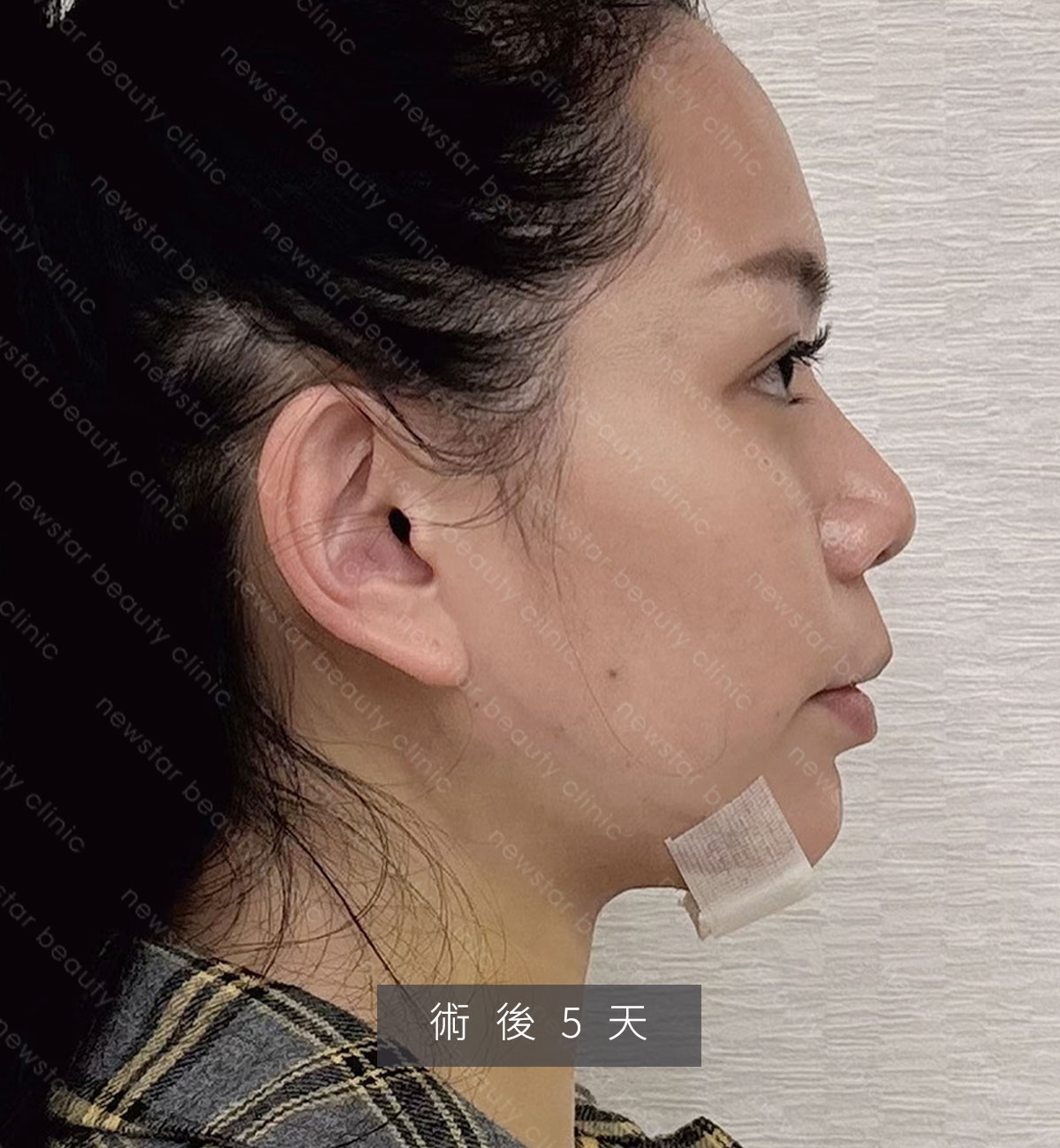 天鵝頸手術_捏捏_術後5天01
