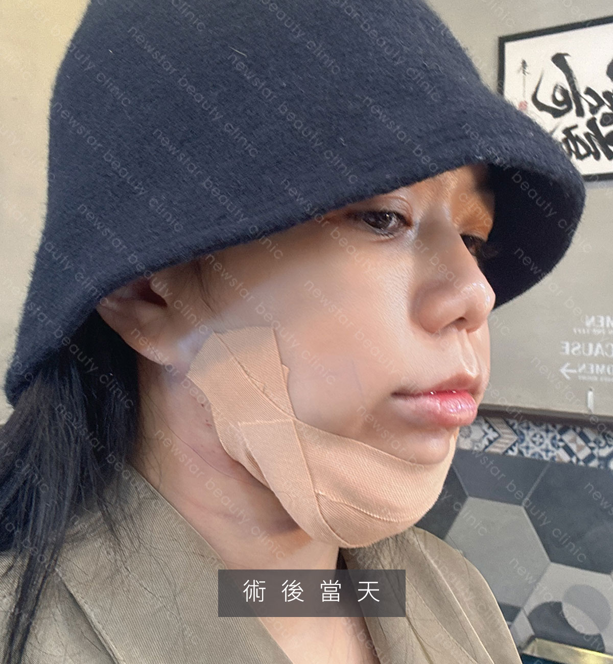 天鵝頸手術_捏捏_術後當天01
