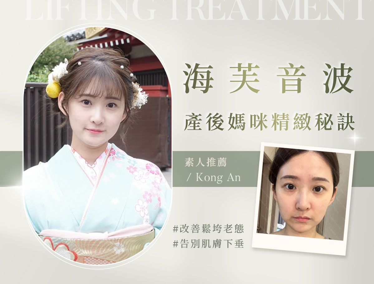 微整官網案例_外bn_孔安_海芙音波01