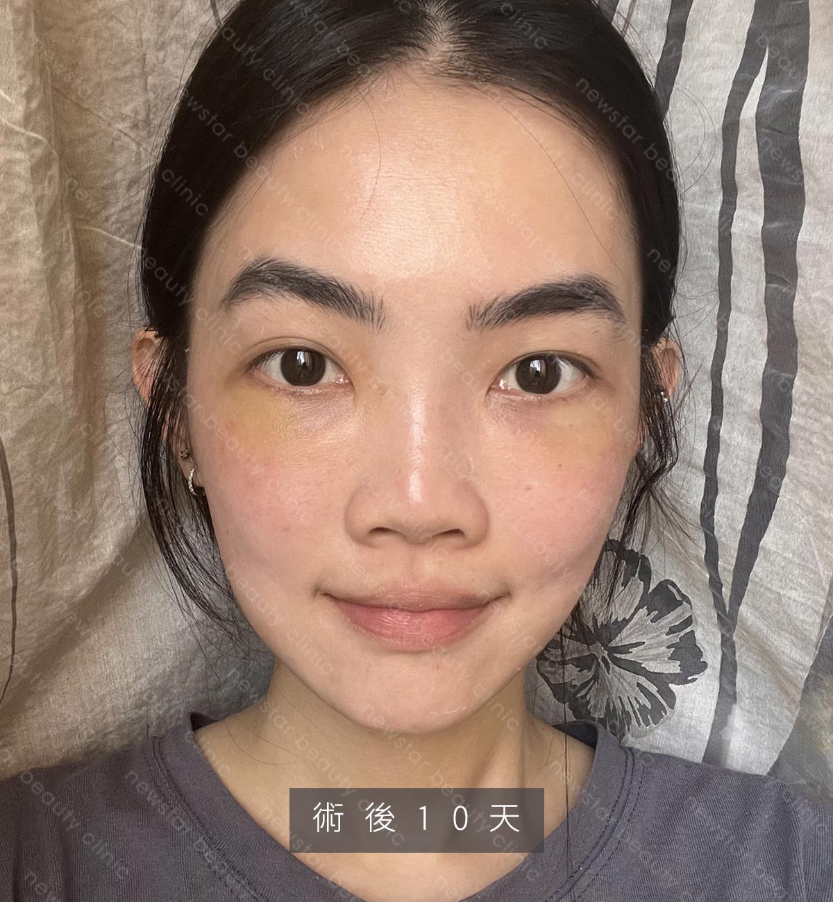 眼袋手術_生活照_術後10天