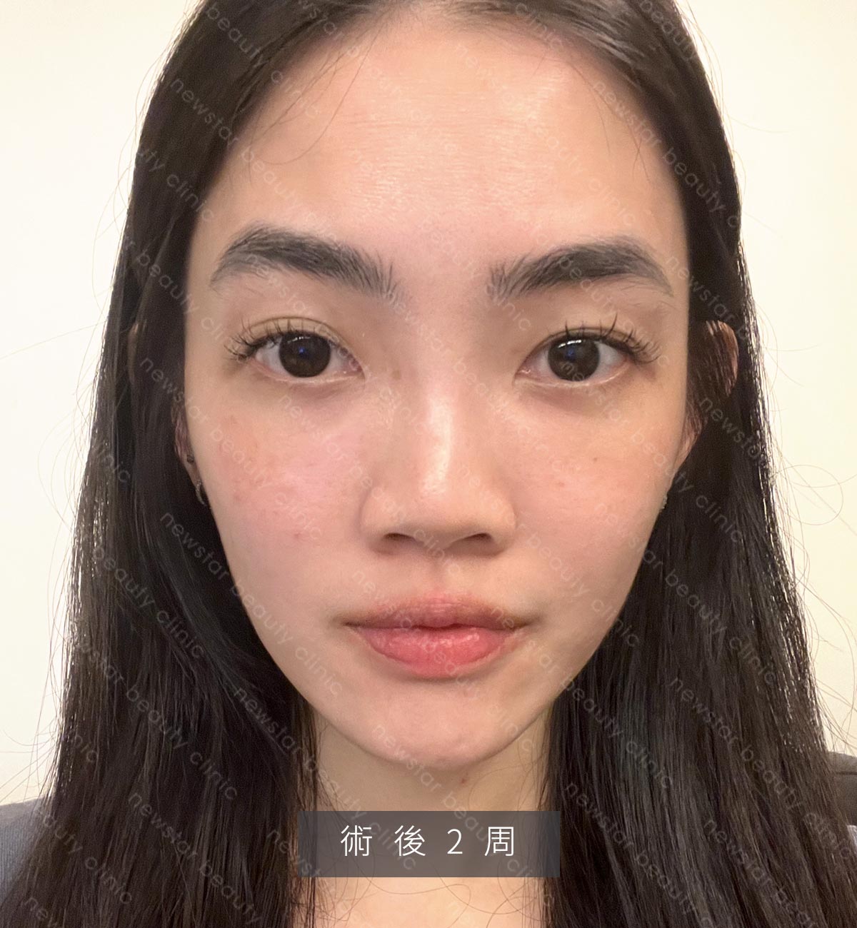 眼袋手術_生活照_術後2周