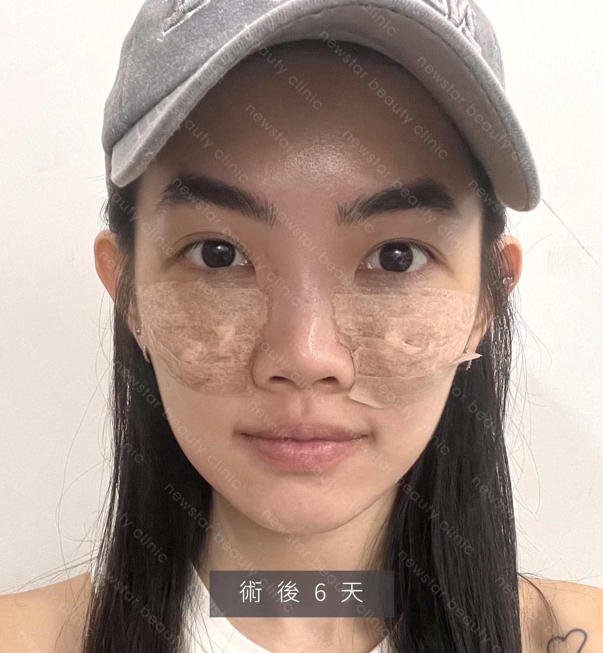 眼袋手術_生活照_術後6天