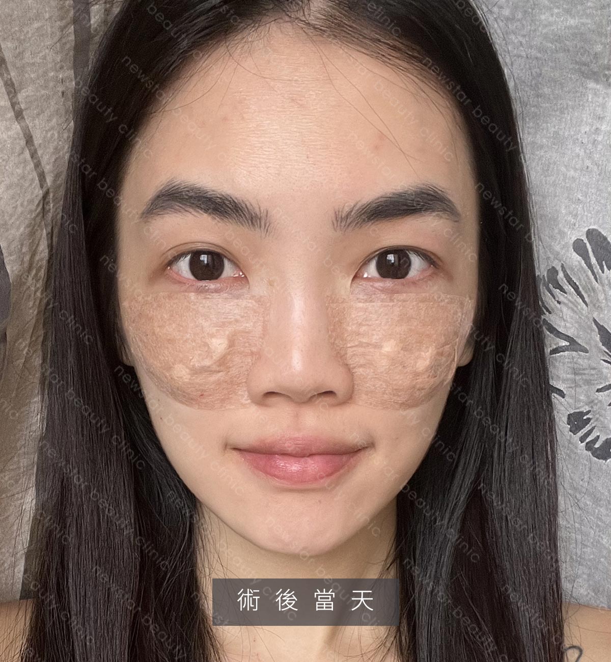 眼袋手術_生活照_術後當天