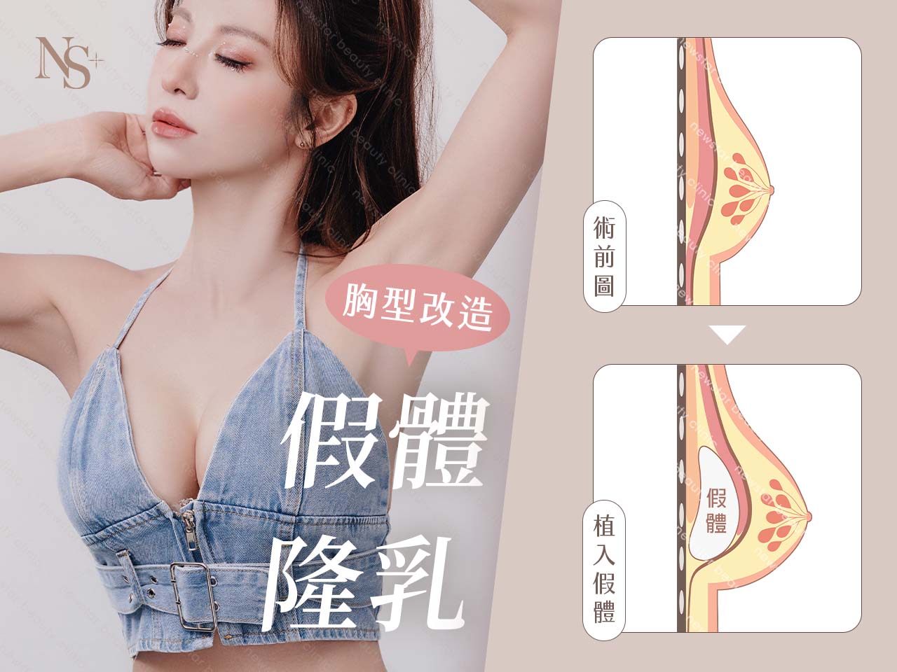 隆乳手術_假體隆乳