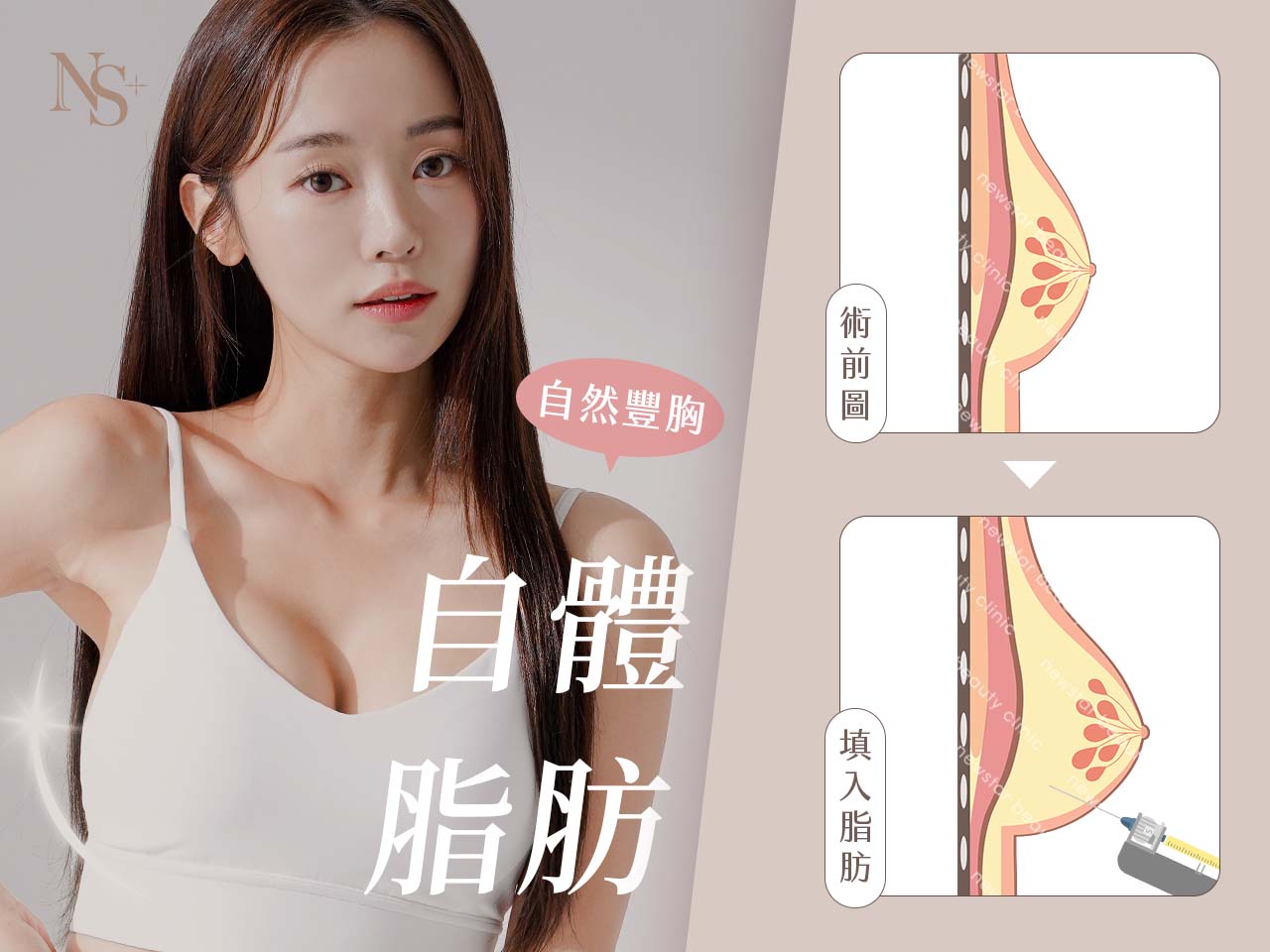 隆乳手術_自體脂肪隆乳