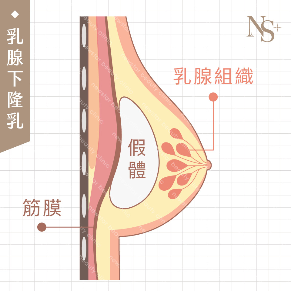 隆乳手術_假體位置_乳腺下