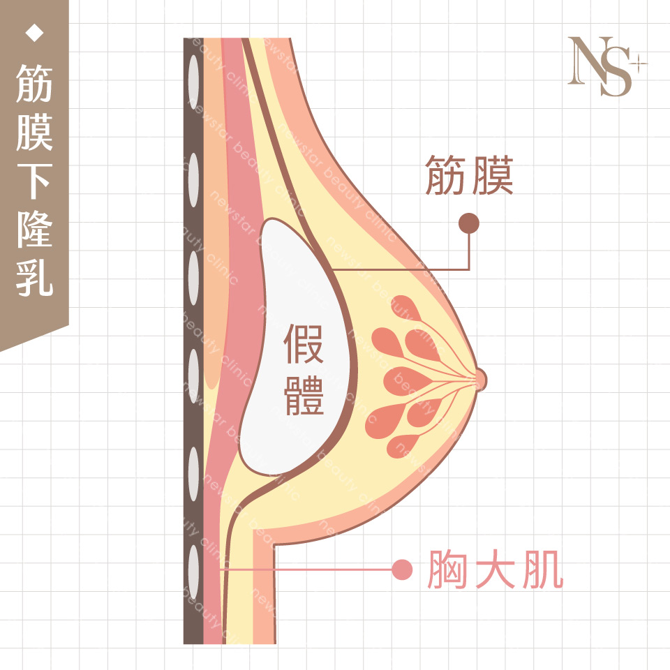 隆乳手術_假體位置_筋膜下