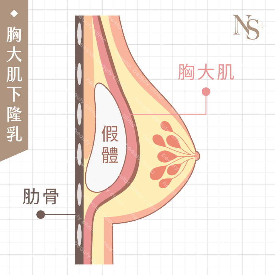 隆乳手術_假體位置_胸大肌下