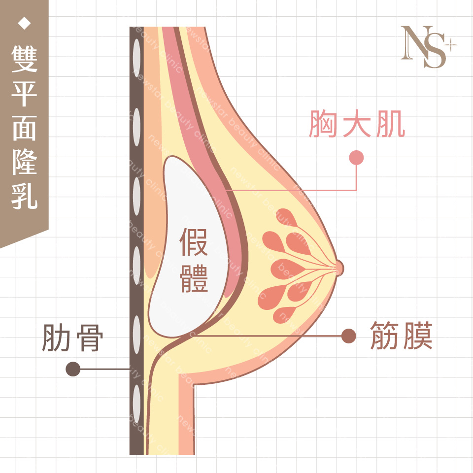 隆乳手術_假體位置_雙平面