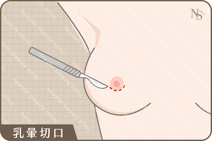 隆乳_四大切口位置_乳暈切口01