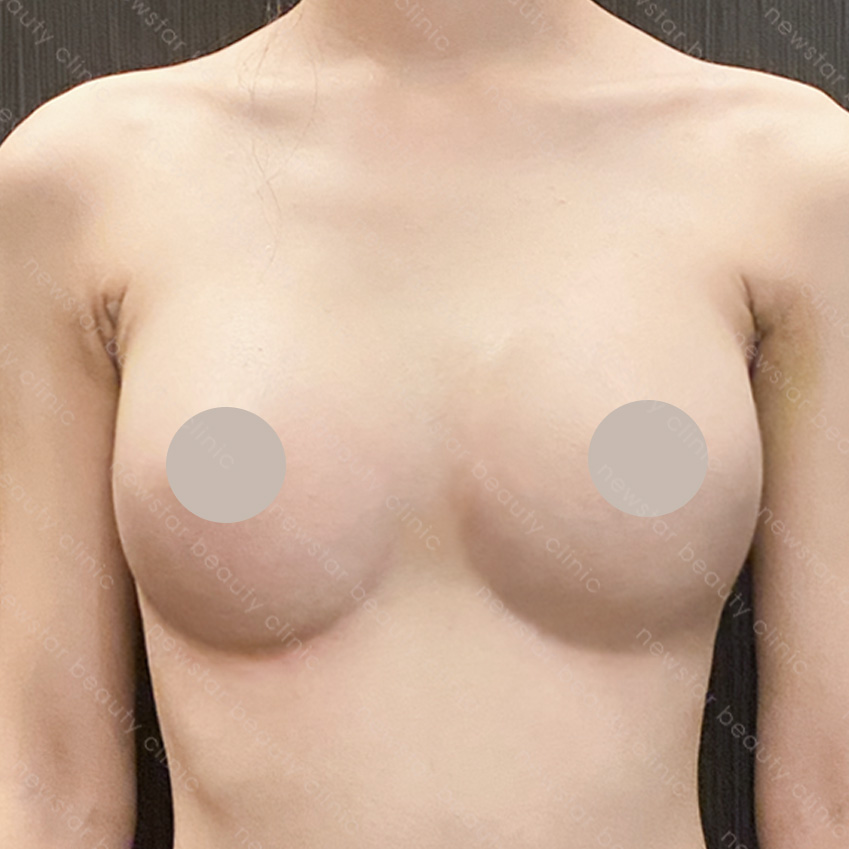 隆乳手術_隆乳恢復過程_1個月