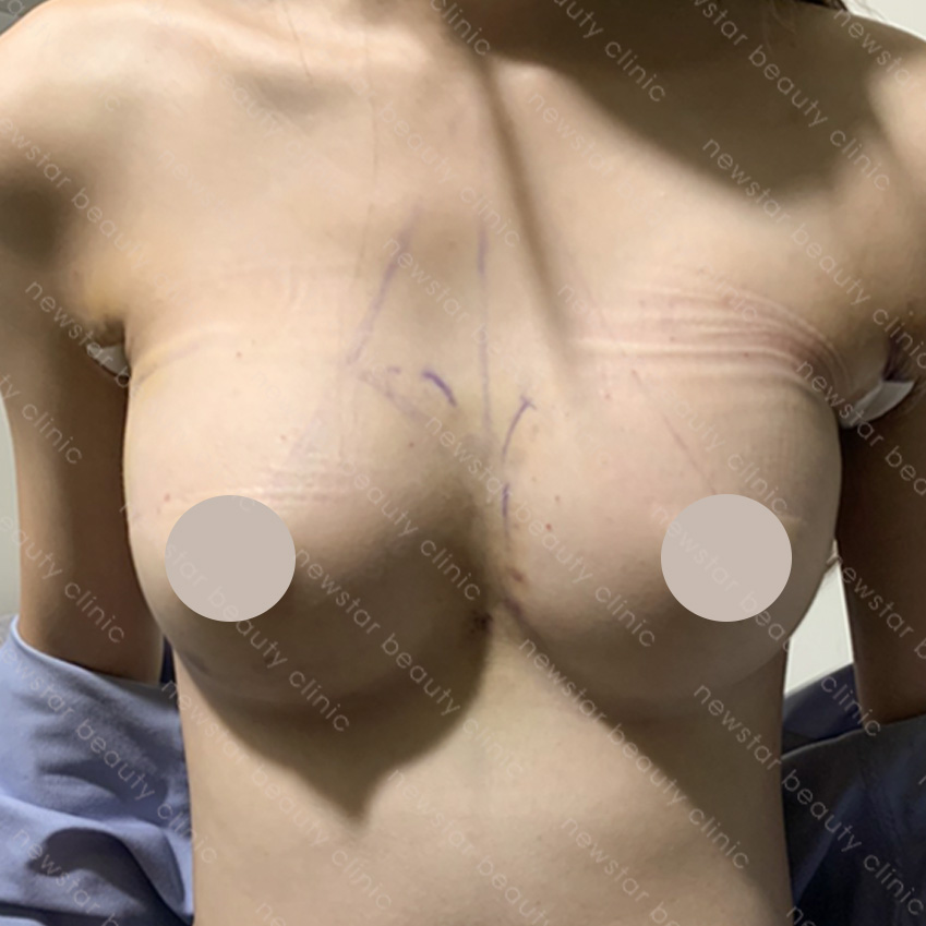 隆乳手術_隆乳恢復過程_2天