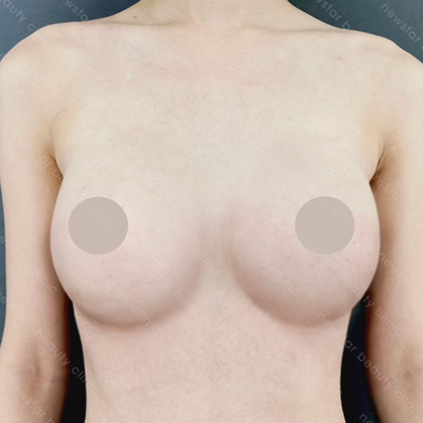 隆乳手術_隆乳恢復過程_3個月