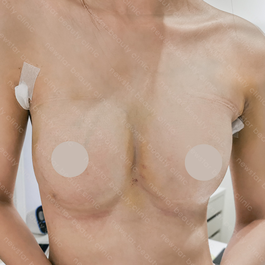隆乳手術_隆乳恢復過程_7天