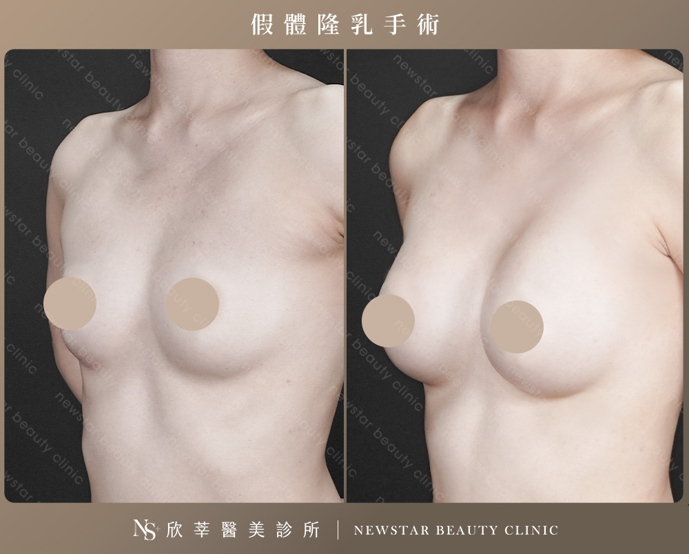 隆乳手術_假體案例1