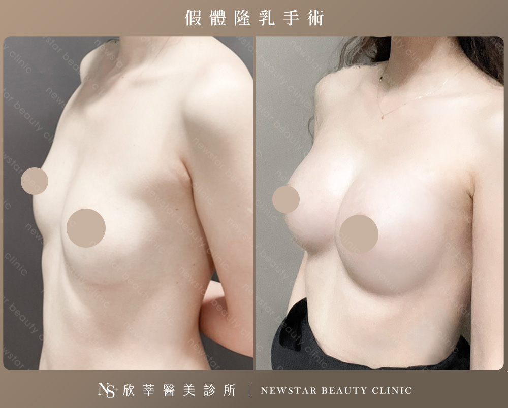 隆乳手術_假體案例2