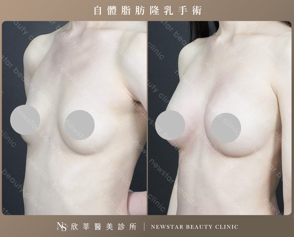 隆乳手術_自體隆乳案例2