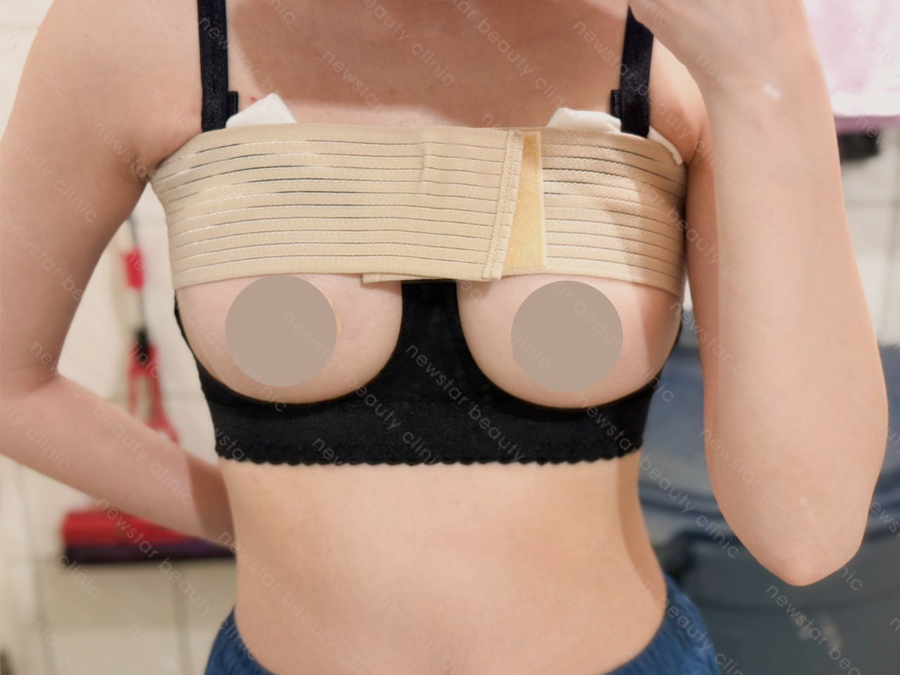 隆乳手術_術後束胸