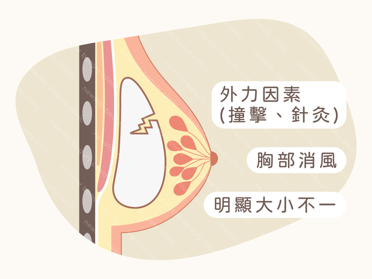 隆乳風險_假體破裂