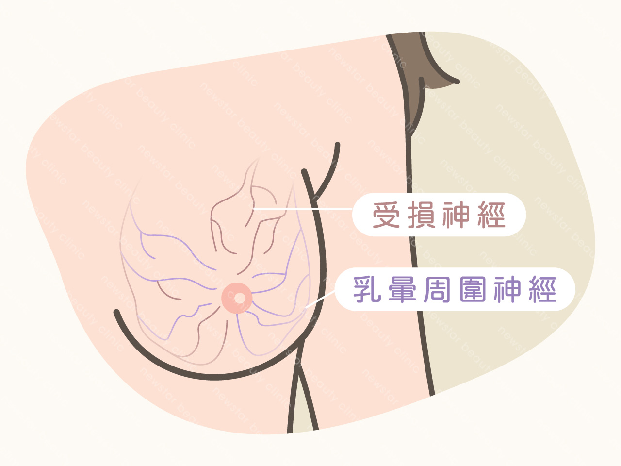 隆乳風險_神經受傷