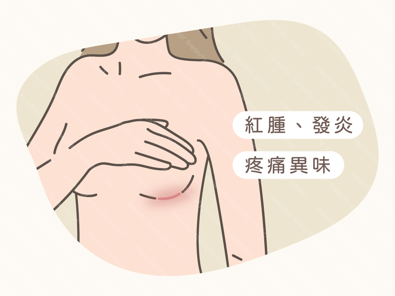 隆乳風險_術後傷口發炎01