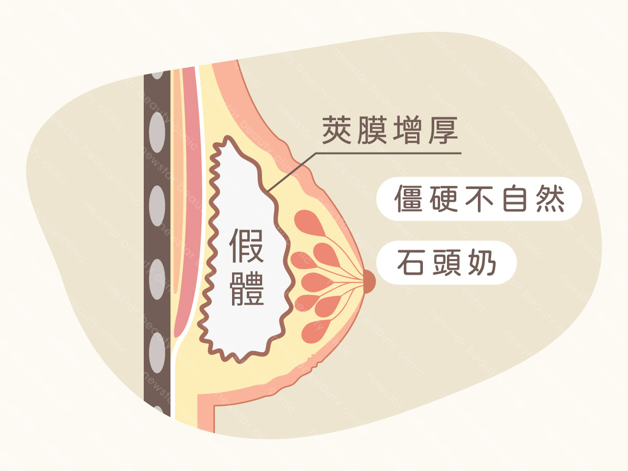 隆乳風險_隆乳莢膜