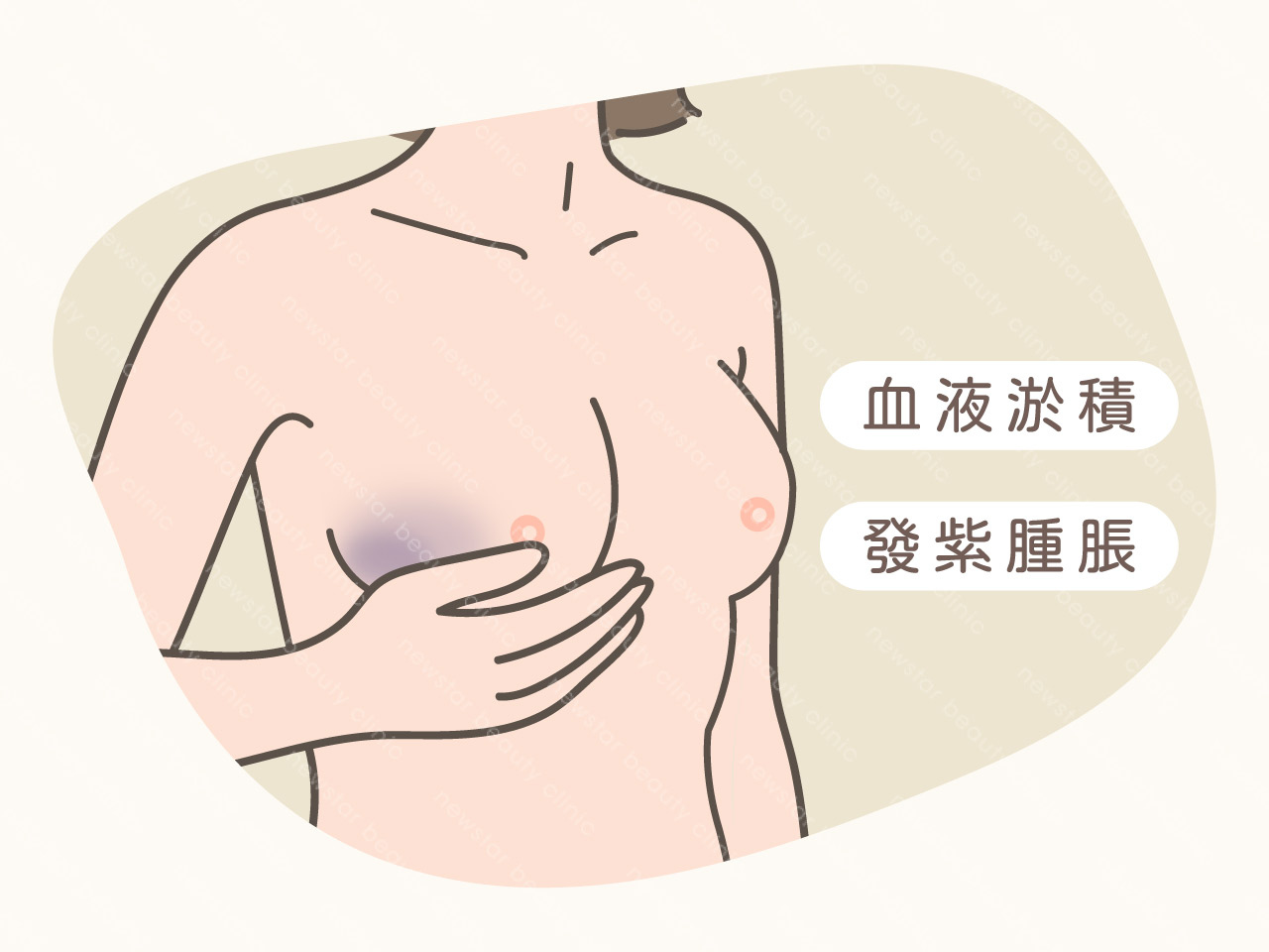 隆乳風險_隆乳血腫