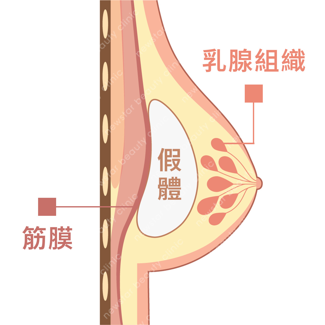 隆乳費用_假體位置_乳腺下