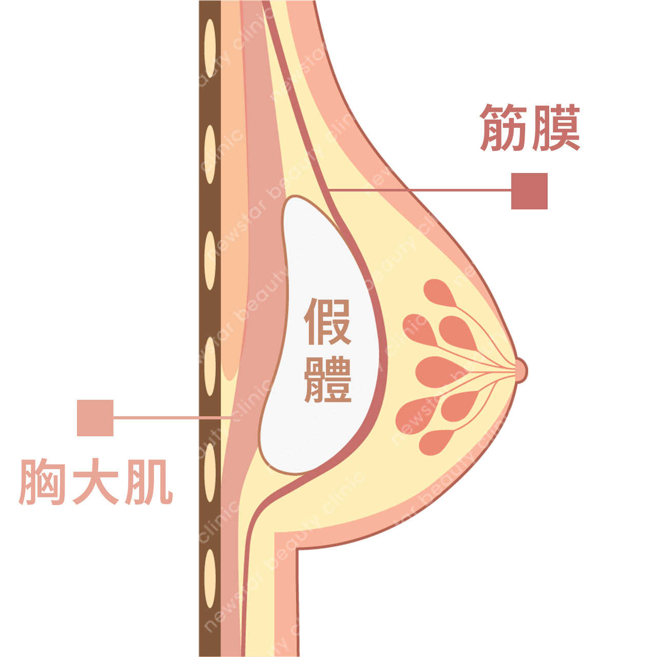 隆乳費用_假體位置_筋膜