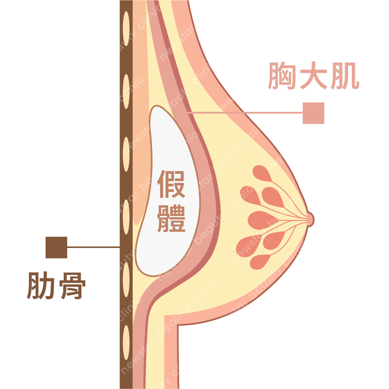 隆乳費用_假體位置_胸大肌