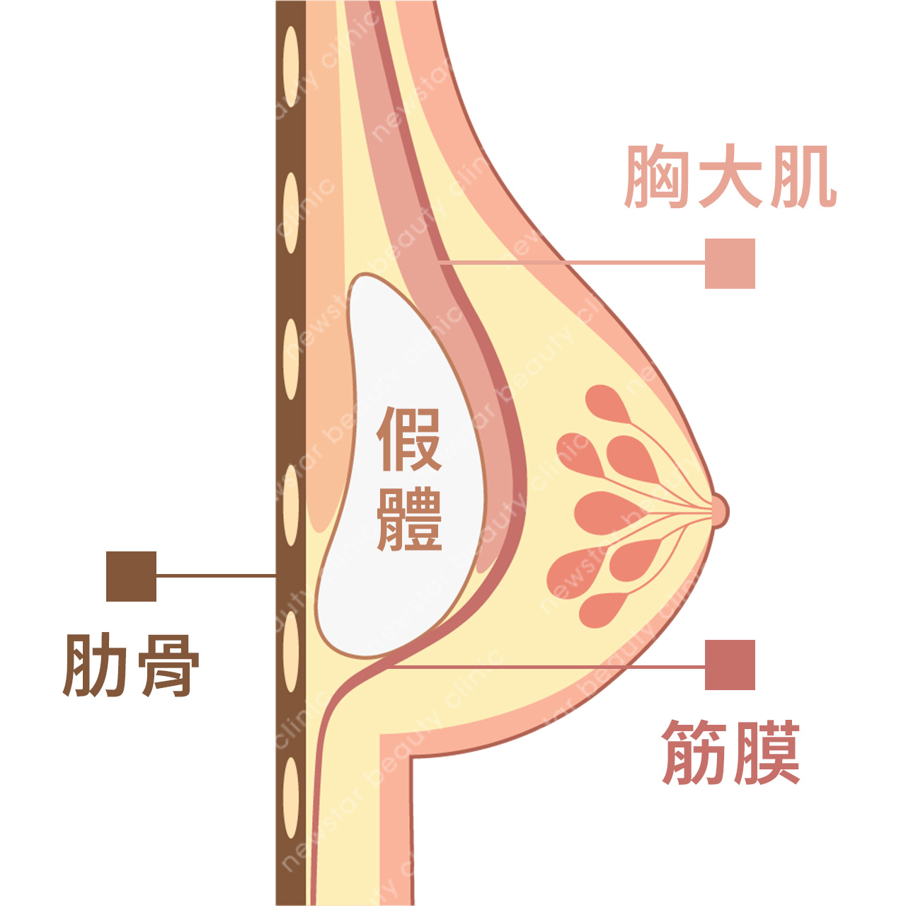 隆乳費用_假體位置_雙平面