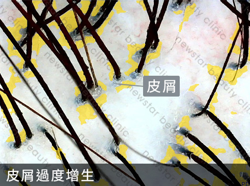 養育髮治療_案例